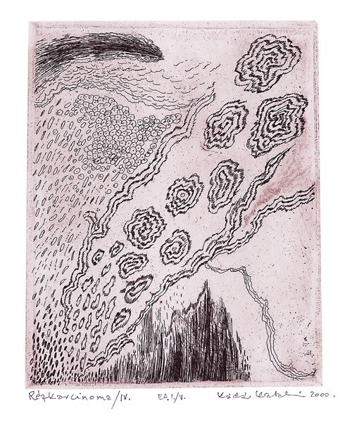 R&eacute;zkarcinoma /4.