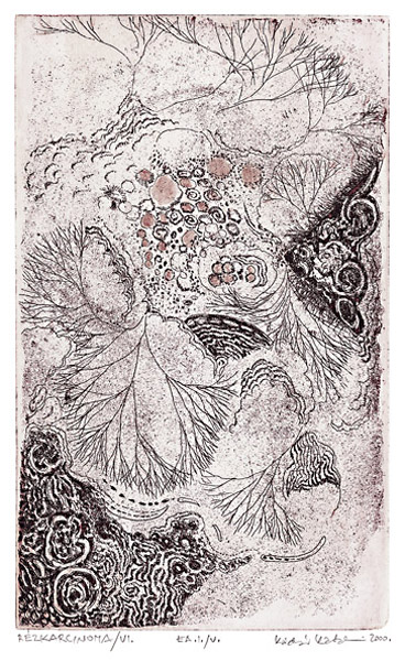 R&eacute;zkarcinoma /6.