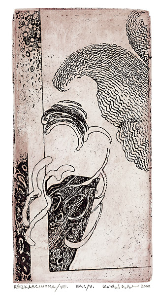 R&eacute;zkarcinoma /8.